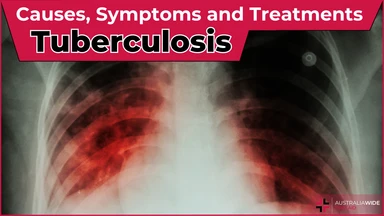 Tuberculosis article header – First Aid Article in Casuarina